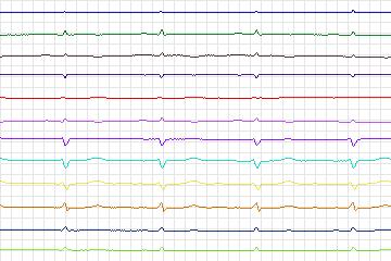 Electrocardiogram for PTB Diagnostic ECG, record s0174lre-patient050