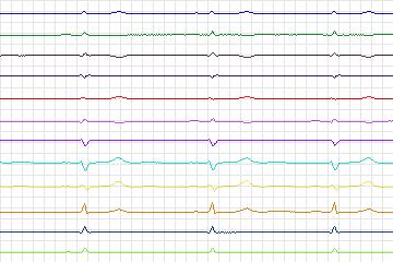 Electrocardiogram for PTB Diagnostic ECG, record s0177lre-patient050
