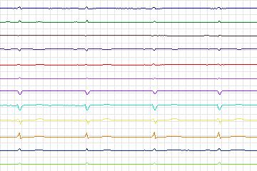 Electrocardiogram for PTB Diagnostic ECG, record s0178lre-patient049