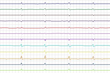 Electrocardiogram for PTB Diagnostic ECG, record s0179lre-patient051