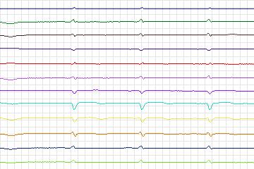 Electrocardiogram for PTB Diagnostic ECG, record s0180lre-patient048