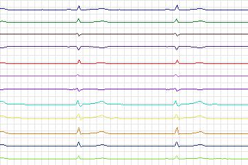 Electrocardiogram for PTB Diagnostic ECG, record s0181lre-patient051