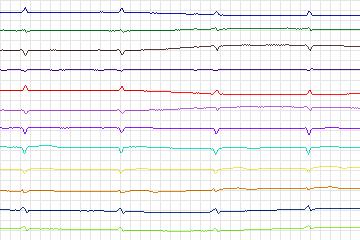 Electrocardiogram for PTB Diagnostic ECG, record s0184lre-patient046