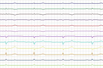 Electrocardiogram for PTB Diagnostic ECG, record s0185lre-patient050