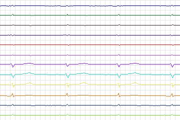 Electrocardiogram for PTB Diagnostic ECG, record s0186lre-patient049