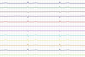 Electrocardiogram for PTB Diagnostic ECG, record s0187lre-patient051