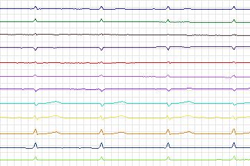 Electrocardiogram for PTB Diagnostic ECG, record s0190lre-patient052