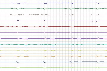 Electrocardiogram for PTB Diagnostic ECG, record s0191lre-patient053