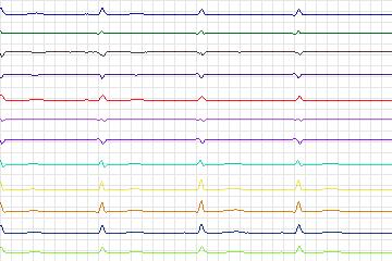 s0192lre-patient054 thumbnail