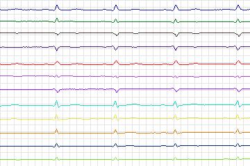 Electrocardiogram for PTB Diagnostic ECG, record s0195lre-patient054