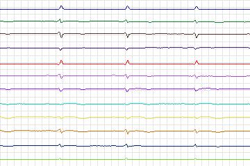 s0212lre-patient062 thumbnail