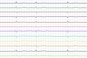 Electrocardiogram for PTB Diagnostic ECG, record s0213lre-patient051