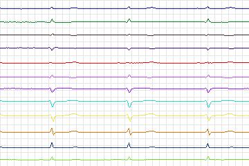 Electrocardiogram for PTB Diagnostic ECG, record s0215lre-patient050
