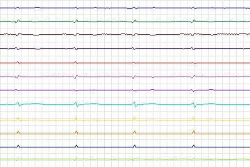 Electrocardiogram for PTB Diagnostic ECG, record s0217lre-patient045