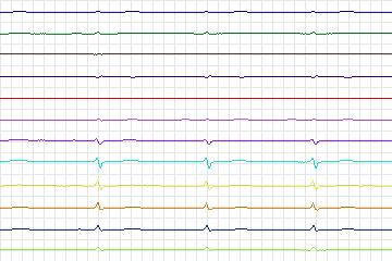 Electrocardiogram for PTB Diagnostic ECG, record s0219lre-patient040