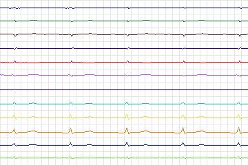 s0220lre-patient064 thumbnail