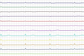 s0221lre-patient065 thumbnail