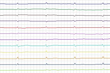 s0225lre-patient066 thumbnail