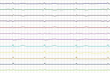 s0229lre-patient065 thumbnail