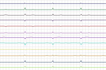 Electrocardiogram for PTB Diagnostic ECG, record s0264lre-patient081