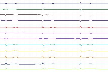 Electrocardiogram for PTB Diagnostic ECG, record s0265lre-patient080