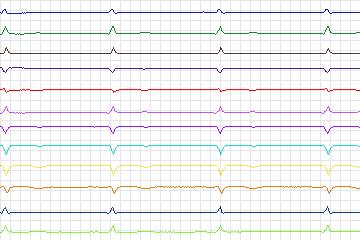 Electrocardiogram for PTB Diagnostic ECG, record s0266lre-patient081