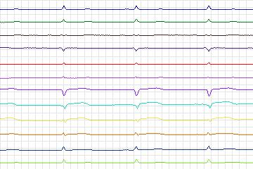 Electrocardiogram for PTB Diagnostic ECG, record s0267lre-patient082