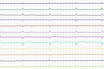 Electrocardiogram for PTB Diagnostic ECG, record s0268lre-patient083