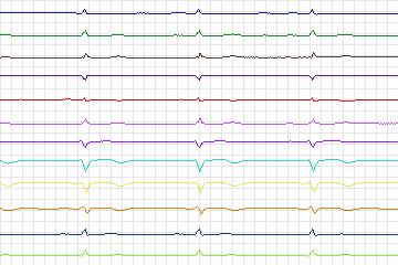 Electrocardiogram for PTB Diagnostic ECG, record s0270lre-patient081