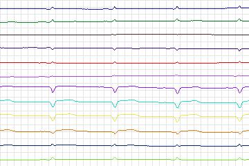 Electrocardiogram for PTB Diagnostic ECG, record s0271lre-patient082