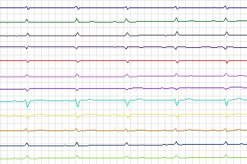 Electrocardiogram for PTB Diagnostic ECG, record s0272lre-patient083