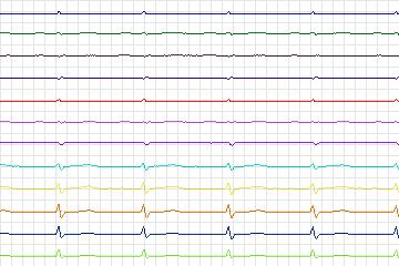 s0274lre-patient170 thumbnail