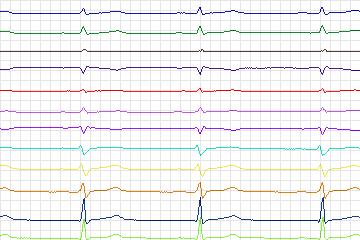 s0275lre-patient166 thumbnail