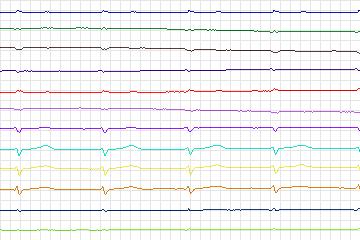 Electrocardiogram for PTB Diagnostic ECG, record s0276lre-patient041