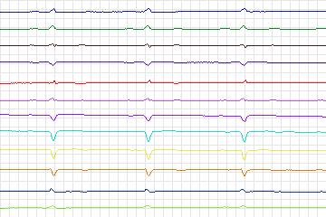 Electrocardiogram for PTB Diagnostic ECG, record s0277lre-patient048
