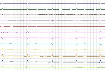 Electrocardiogram for PTB Diagnostic ECG, record s0278lre-patient043