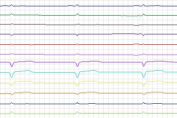 Electrocardiogram for PTB Diagnostic ECG, record s0279lre-patient082