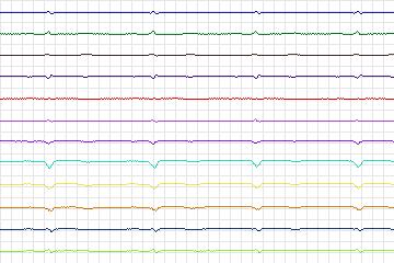 Electrocardiogram for PTB Diagnostic ECG, record s0281lre-patient084