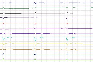 Electrocardiogram for PTB Diagnostic ECG, record s0286lre-patient083