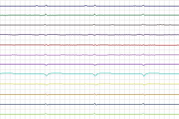 Electrocardiogram for PTB Diagnostic ECG, record s0288lre-patient084