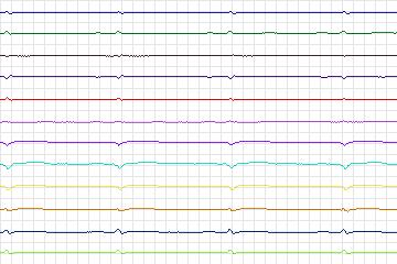 Electrocardiogram for PTB Diagnostic ECG, record s0289lre-patient084