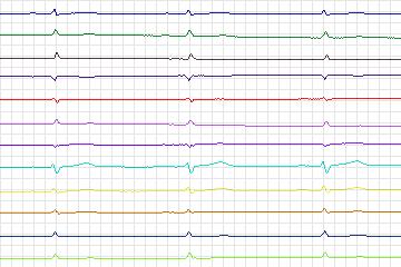 Electrocardiogram for PTB Diagnostic ECG, record s0290lre-patient083