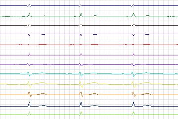 s0291lre-patient117 thumbnail