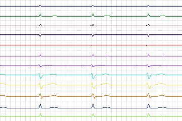 s0292lre-patient117 thumbnail