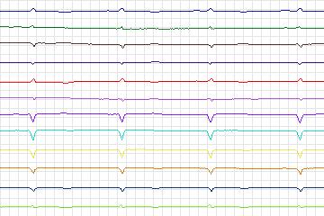 s0294lre-patient158 thumbnail