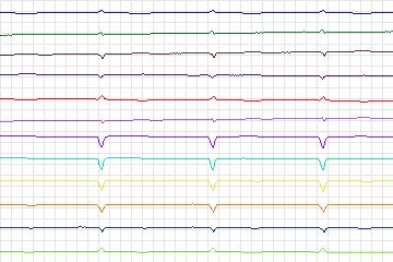 s0295lre-patient158 thumbnail