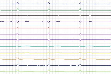 s0296lre-patient085 thumbnail