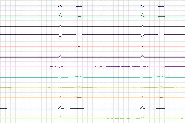 s0298lre-patient085 thumbnail