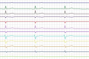 Electrocardiogram for PTB Diagnostic ECG, record s0299lre-patient156