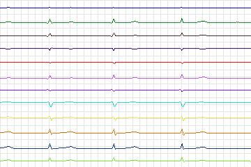 s0300lre-patient174 thumbnail